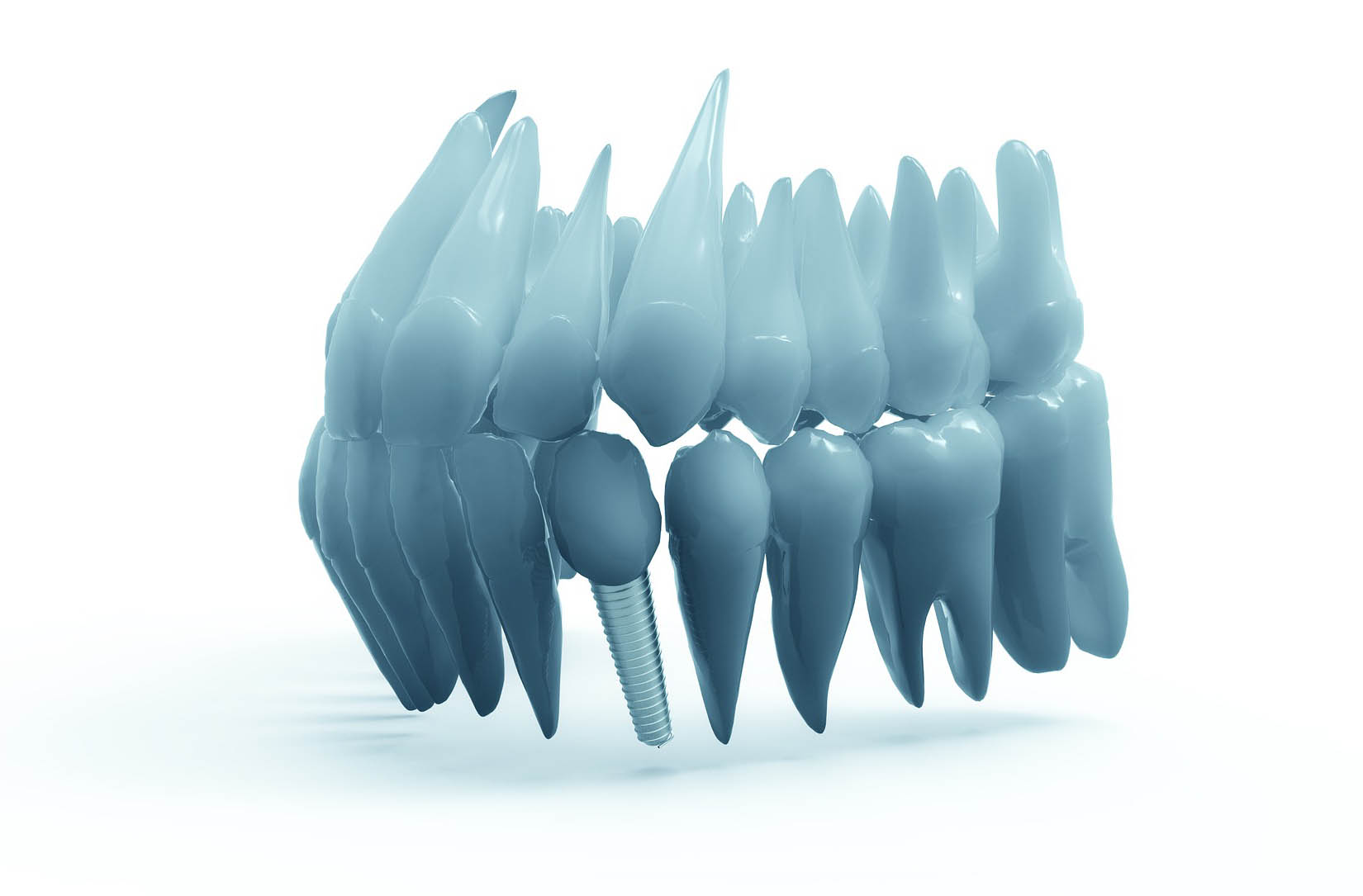 Implantes Dentales